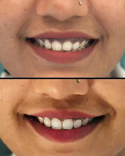 Before and after smile showing improved tooth appearance after dental treatment.