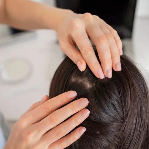 Anti-dandruff therapy Kochi