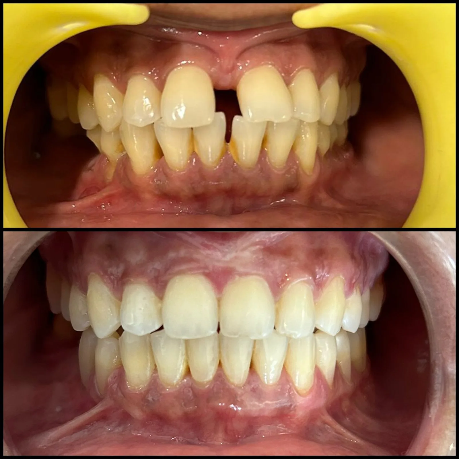 Before and after dental treatment showing improved tooth alignment and appearance.