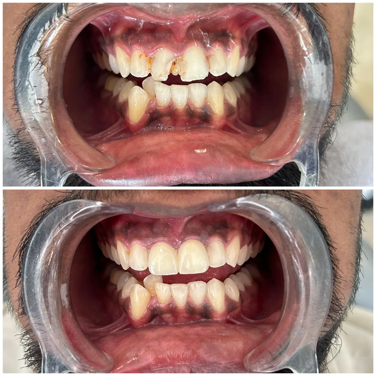 Before and after dental treatment showing improved smile and teeth alignment.