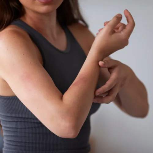 Skin Allergy Treatment Kochi