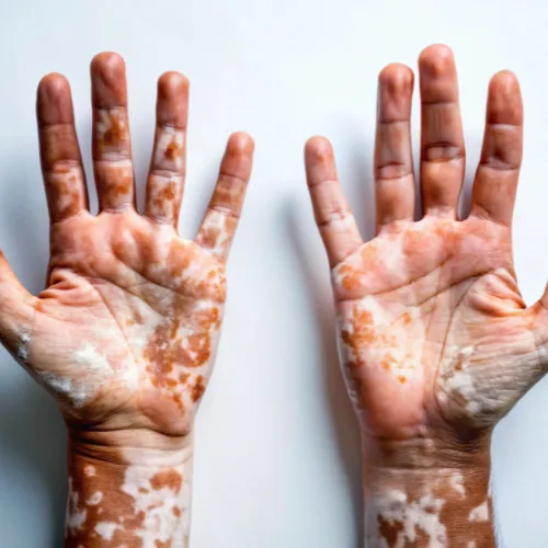 Vitiligo Treatment Kochi