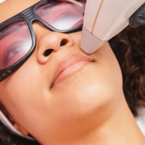 Upper Lip Laser Hair Removal Kochi