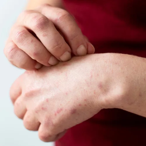 Skin Infections Treatment Kochi