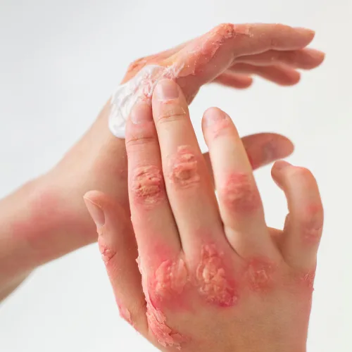 Rashes Treatment Kochi