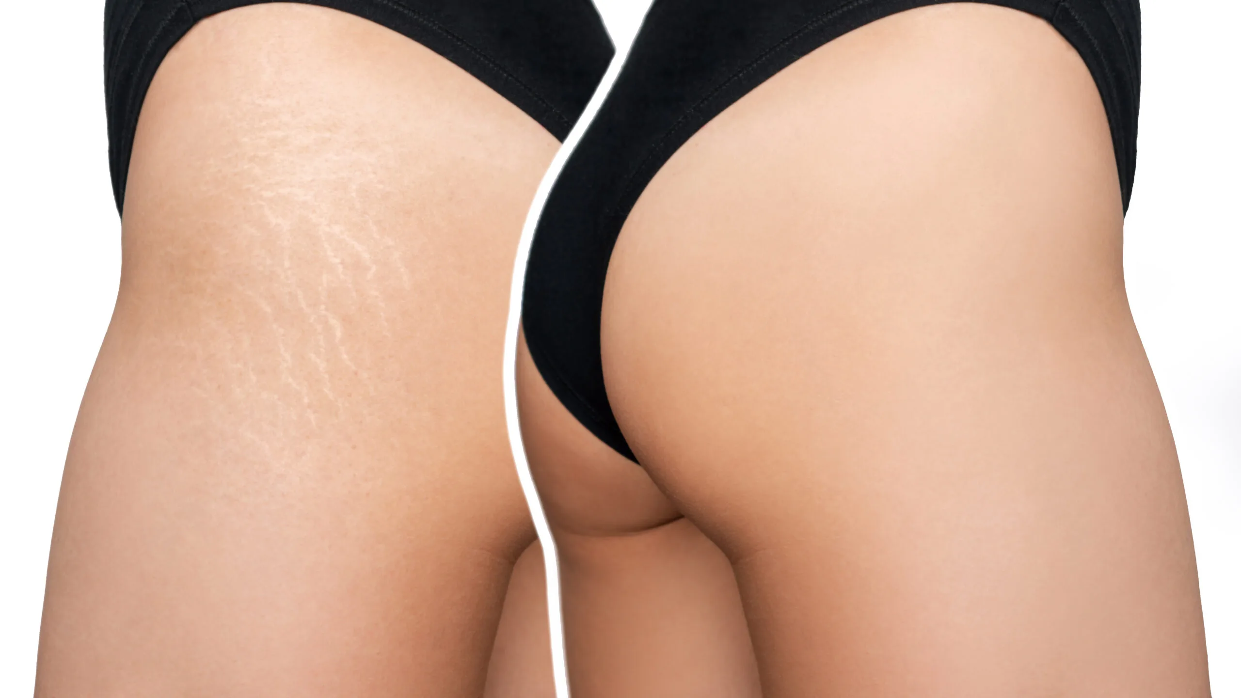 Stretch Marks Reduction Kochi