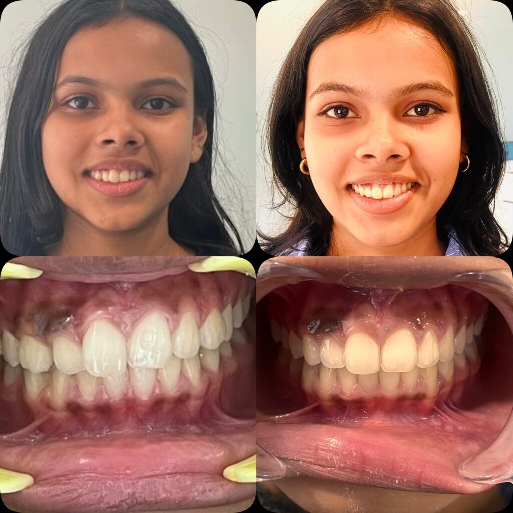 a girl before and after novocare's smile makeover treatment.
