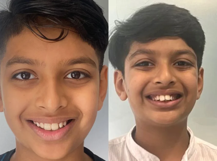 A boy before and after novocare's smile makeover treatment.